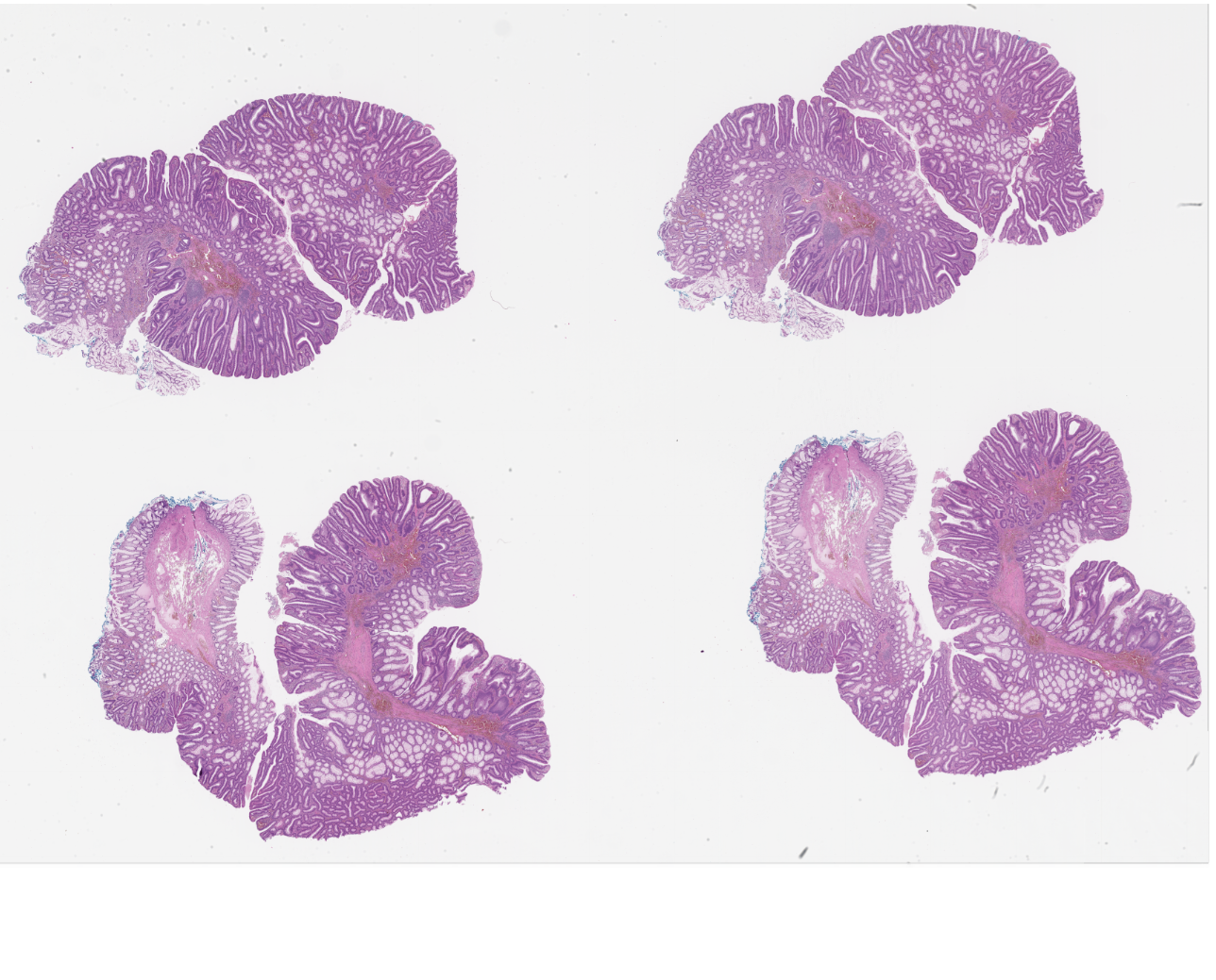 H&E stained digital image of resected polyps